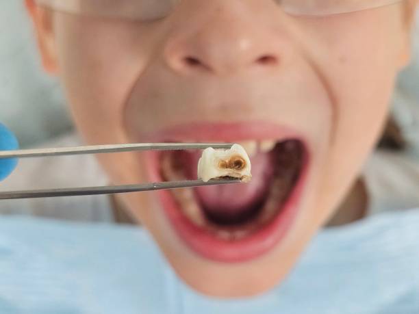 Best Broken or Chipped Tooth Repair in South Taft, CA